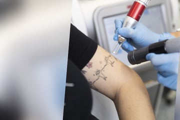 Leipzig: "Lasersprechstunde": Leipziger Uniklinik entfernt unliebsame Tattoos