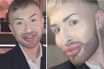 Mann lässt sich jahrelang das Gesicht aufspritzen: So heftig anders sieht er heute ohne Filler aus