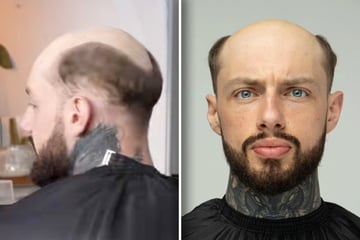 Schon mit 18 Jahren eine Glatze: Als sich junger Mann mit vollem Haar sieht, ist er sprachlos