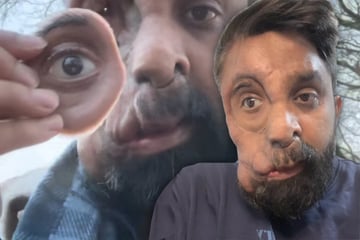 Leute fragen ihn, ob er eine Grusel-Maske trägt: Darum sieht dieser Mann so besonders aus