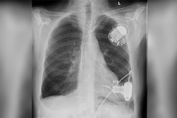 Heute vor 40 Jahren: Auch in Deutschland erste Schritte zur Lebensverlängerung