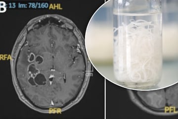 Ärzte suchen nach Krebs, doch im Gehirn des Patienten machen sie eine unerwartete Entdeckung