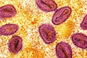 California health authorities confirm first US case of infection with new mpox strain