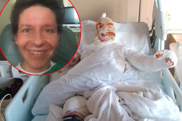 Selbst gebaute Sauna explodiert: Frau hängt Haut nach verheerender Stichflamme in Fetzen vom Gesicht