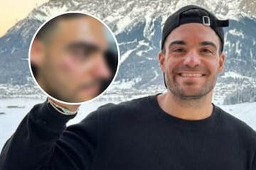 Heftiger Unfall mit heißem Fett: Koch-Influencer zeigt entstelltes Gesicht