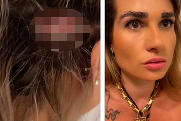 Frau lässt sich Haare vom Hinterkopf als Augenbrauen transplantieren, doch die Sache hat einen Haken