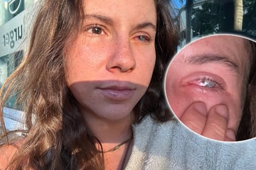 Tagelang Augenschmerzen: Parasit frisst sich durch Auge von Frau