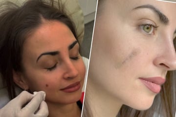 Ekaterina Leonova meldet sich nach OP zu Wort: Muttermal wäre Hautkrebs geworden!