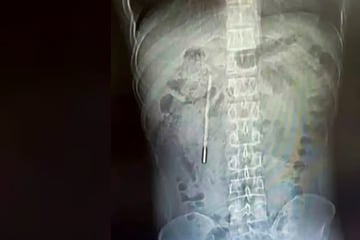Ärzte entdecken Thermometer in Körper eines Mannes - was er 20 Jahre zuvor verschluckt hatte