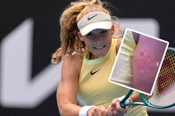 Das sieht böse aus: Tennis-Supertalent beißt sich selbst in den Arm!
