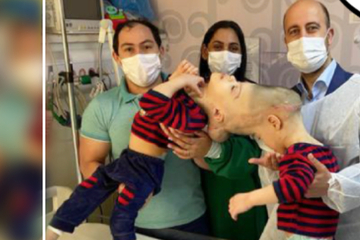 Zwillinge am Kopf zusammengewachsen: Ärzte-Team gelingt Unglaubliches