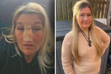 Frau denkt, sie habe Heuschnupfen, doch die Wahrheit ist viel schlimmer