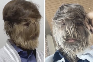 Real life teen wolf: Teenager with rare disease wins world record for "hairiest face"