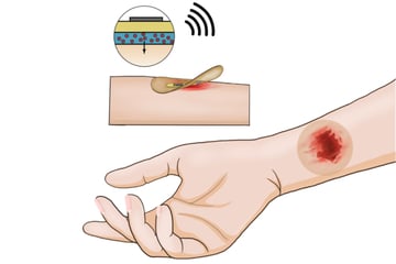 A new "smart" band-aid designed by scientists may heal wounds 25% faster