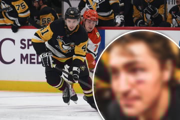 Puck im Gesicht: Eishockey-Star zeigt seine Aua-Wunde!