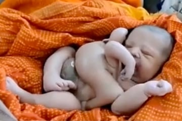 Baby mit vier Armen und Beinen geboren