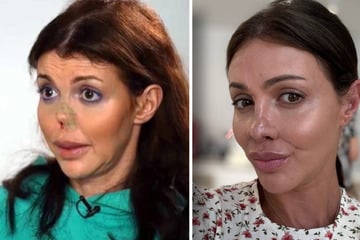 Model nach verpfuschter Beauty-OP völlig entstellt: Endlich hat Alisa eine neue Nase