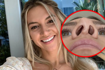 Influencerin nach OP-Pfusch völlig genervt: Follower loben "tolle Nase", dabei hasst sie ihren Zickzack-Zinken