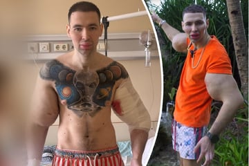 Ärzte besorgt: "Russki Popeye" spritzte sich jahrelang Öl in den Bizeps, nun droht ihm die Arm-Amputation