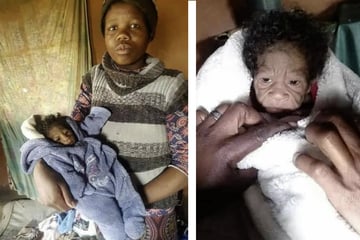 South African baby girl born with incredibly rare condition