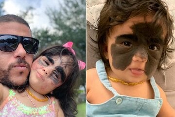 Baby with Batman mask birthmark becomes social media superstar as she gets miracle treatment!