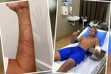 Urlaub verwandelt sich in Horror-Trip: Surfer von ultragiftigem Tier gestochen