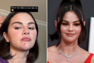 Selena Gomez reveals breakouts in stripped-down selfie: "Even my skin is over me rn"