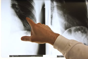 Berlin: Neue Zahlen zeigen: Daran sterben die meisten Menschen in Berlin und Brandenburg