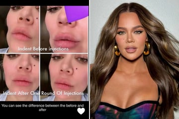 Khloé Kardashian shows off results of face injections after skin cancer scare