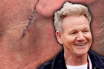 Dicke Narbe unterm Ohr: Star-Koch hat Hautkrebs
