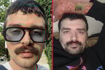 Man hospitalized after his Charli XCX-inspired Brat tattoo gets horribly infected