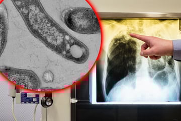 Dresden: Tuberkulose-Alarm an Dresdner Schulen! Erkrankte isoliert