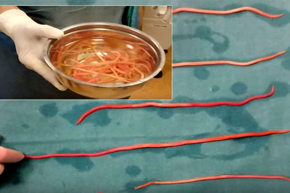 Diese riesigen Würmer entfernten die Ärzte der Frau aus dem Gallengang.