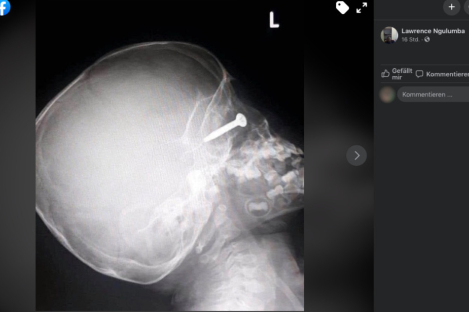 Die Röntgenaufnahmen zeigen, welches Glück der Dreijährige hatte.