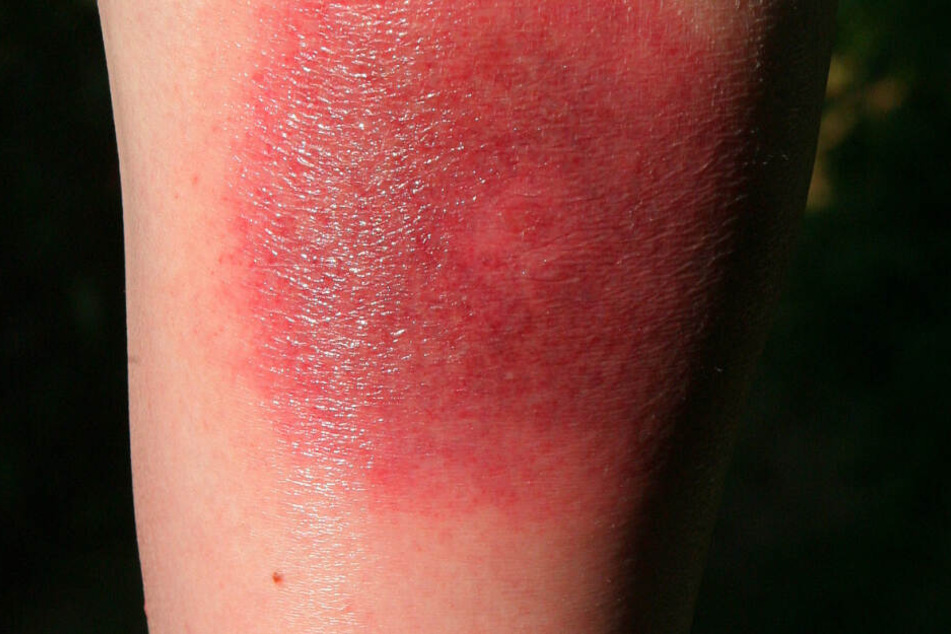 So kann es nach einem Zeckenbiss aussehen. Ein klares Warnzeichen für Borreliose: Die sogenannte Wanderröte kann noch Tage oder Wochen später auftreten.