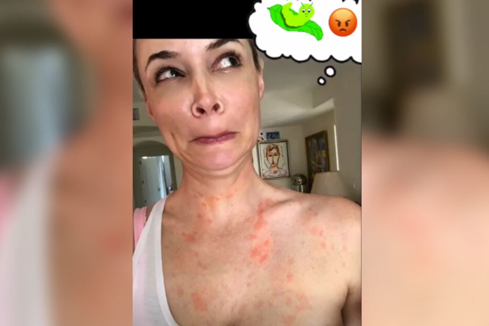 Die fiesen Quaddeln sind bei Daniela nicht zu übersehen. (Screenshot)