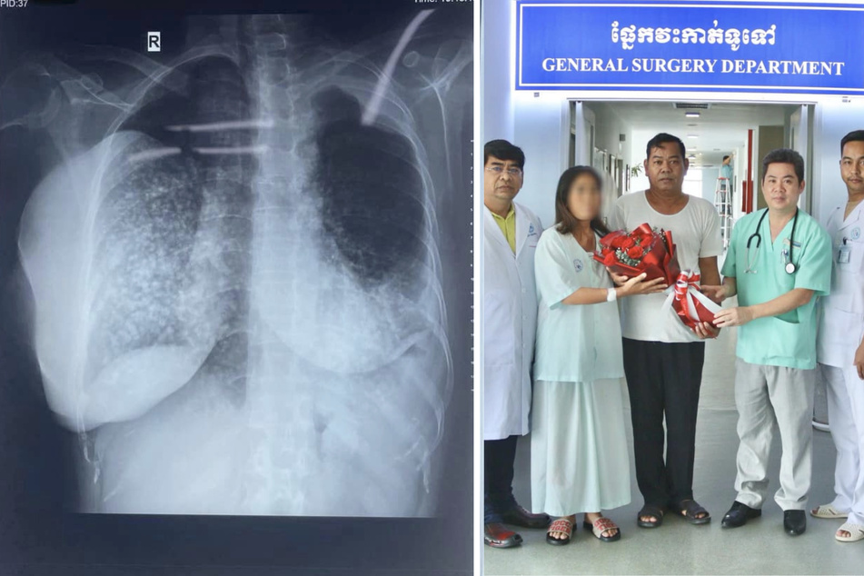 Bei einer 44-jährigen Frau aus Kambodscha wurde ein 2,5-Kilo-Tumor entdeckt und herausoperiert.