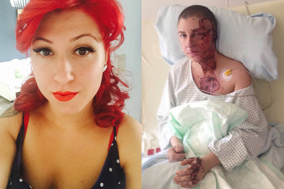 Vorher und nachher: Seit dem Angriff musste Vanessa bereits 20 Mal operiert werden.