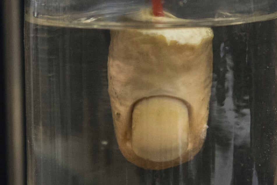 Der Finger konnte nicht mehr angenäht werden. (Symbolbild)