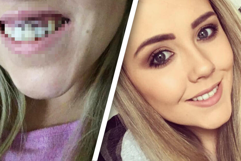 Junge Frau will sich die Zähne aufhellen lassen, die Folgen sind schrecklich