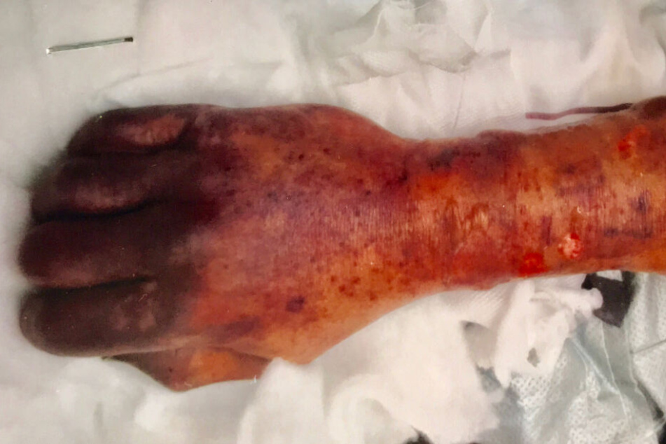 Eine Woche nach Aufnahme im Krankenhaus sah der rechte Arm mit Hand des Patienten unverändert aus. Dafür machte sich eine Nekrose bemerkbar.