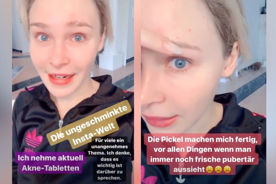 Bei Instagram zeigt sich die 27-Jährige ungeschminkt und mit unreiner Haut.