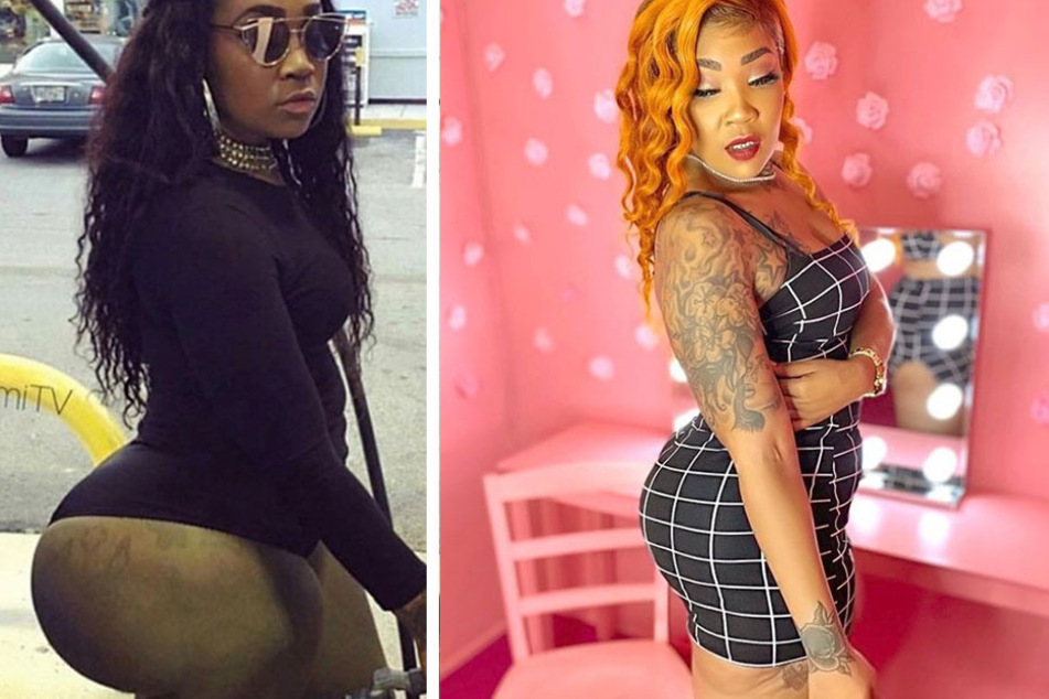 "Ms. Miami" reshapes her life – and her butt – after illegal injections cause havoc