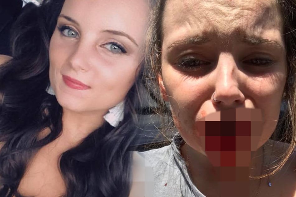 Horror-Angriff! Ex-Freund beißt junger Frau nach Trennung die Lippe ab