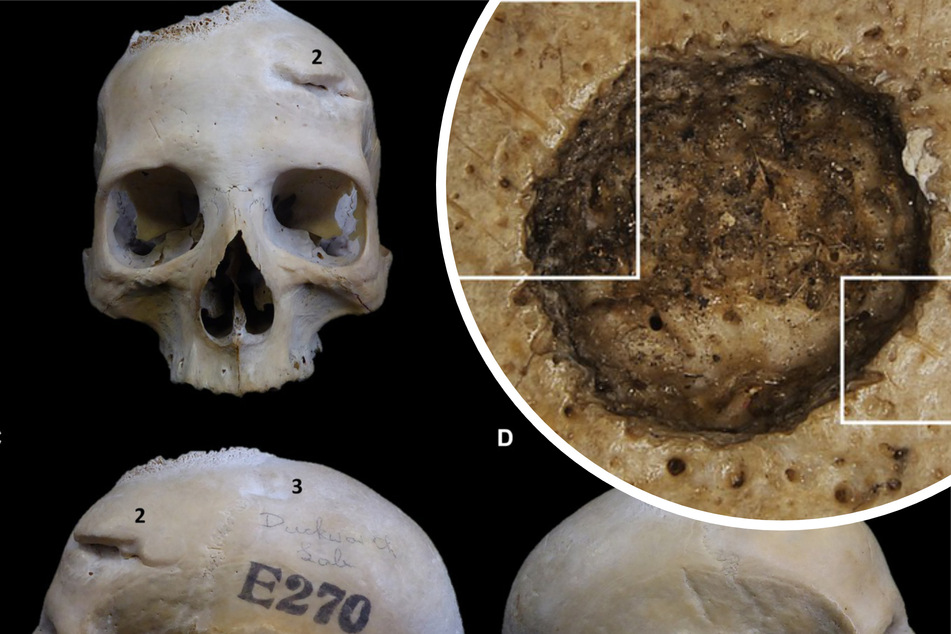 Jahrtausende alt: Schädel weist Spuren von erster Krebsbehandlung auf!