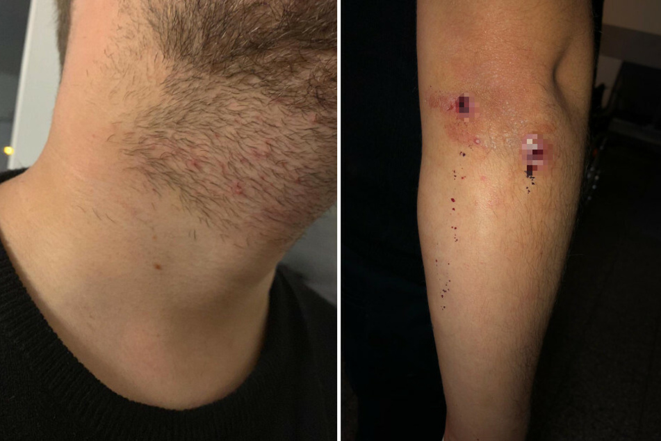 Das Foto zeigt die Würgemale am Hals und die Verletzungen am Arm des Fotografen.