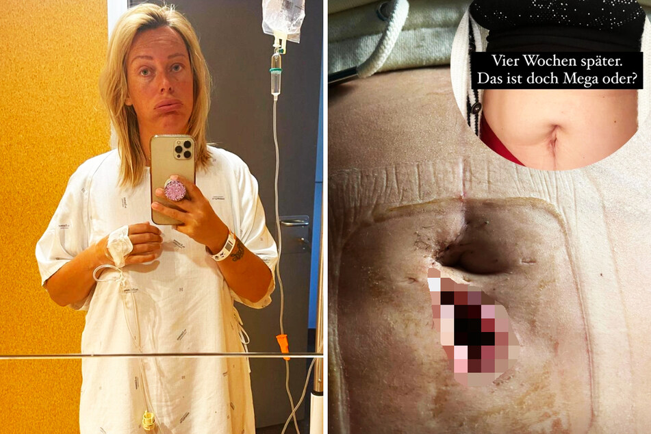 TV-Auswanderin Julia Holz (35) hat auf Instagram erneut ein Foto ihres offenen Lochs in der Bauchdecke veröffentlicht.