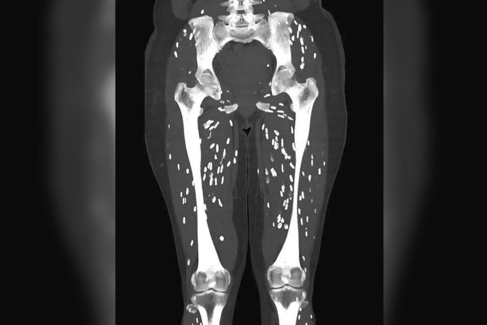 Bei diesem CT-Scan kann einem ganz anders werden: Er zeigt eine parasitäre Infektion.