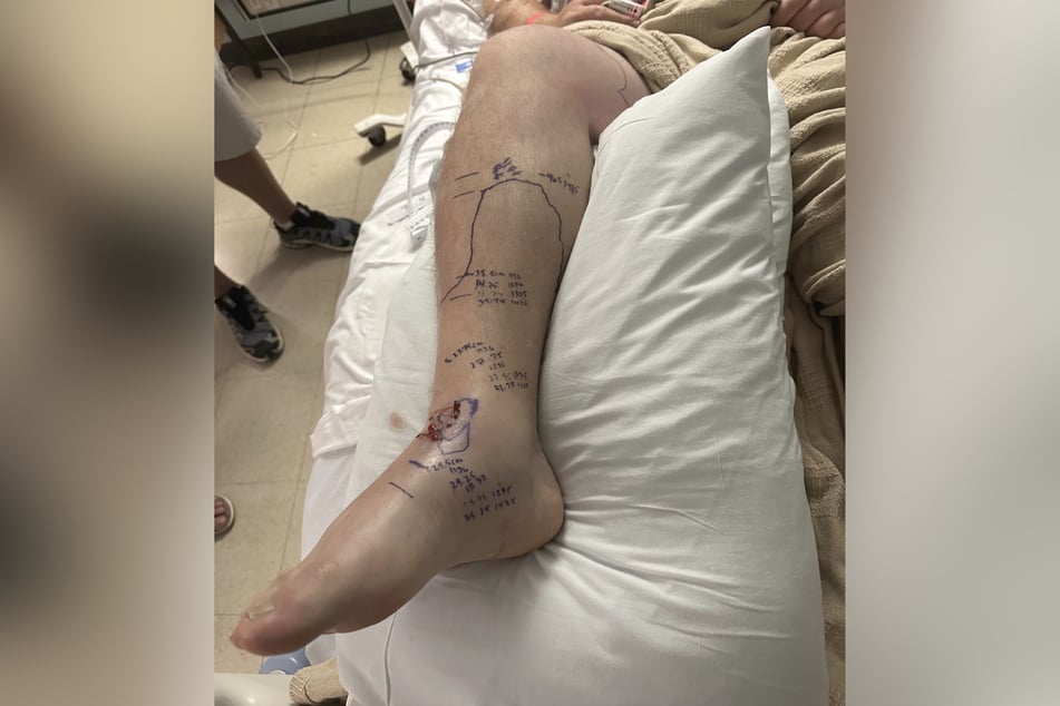 Nach den Klapperschlangenbissen kämpft Chris Howarth tagelang im Krankenhaus um sein Leben.