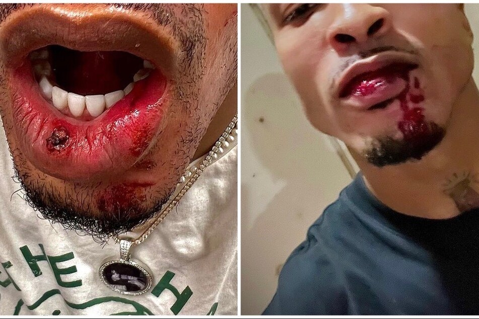 August Alsina dropped more up-close shots of his injuries from his alleged attack by Tory Lanez.